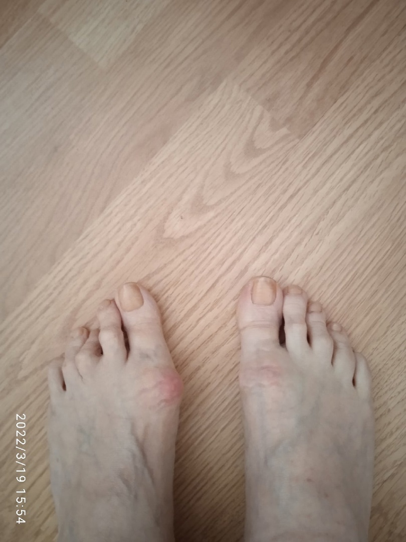 Фотография покупателя товара Корректоры-разделители для пальцев ног, с накладкой на косточку большого пальца, 1 разделитель, силиконовые, 7,5 × 6 см, пара, цвет белый - Фото 2